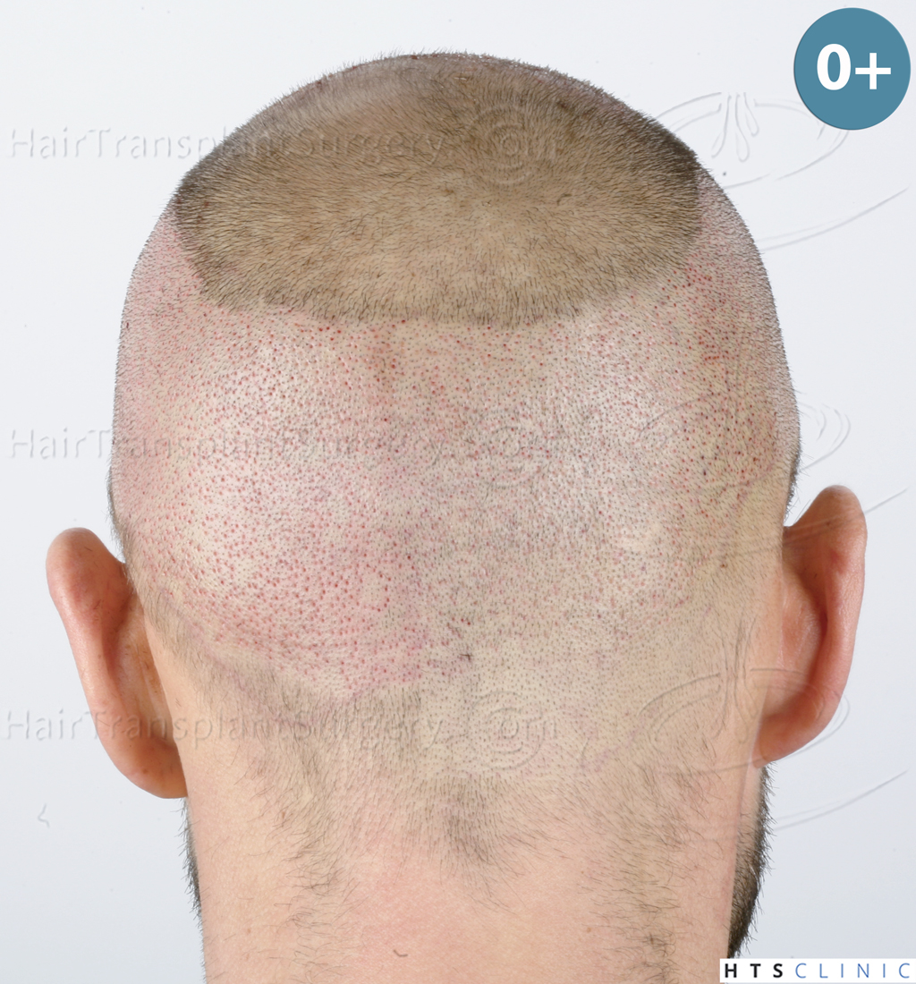 Dr.Devroye-HTS-Clinic-5530-FUE-_3545_198