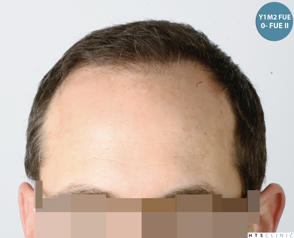 Dr.Devroye-HTS-Clinic-5530-FUE-_3545_198