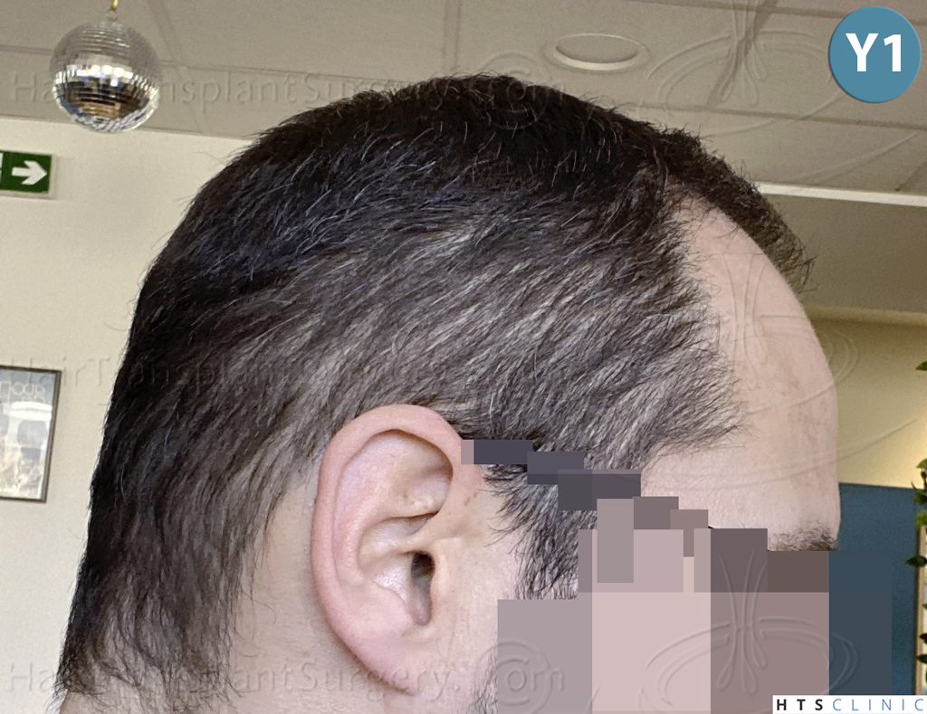 Dr.Devroye-HTS-Clinic-5530-FUE-_3545_198