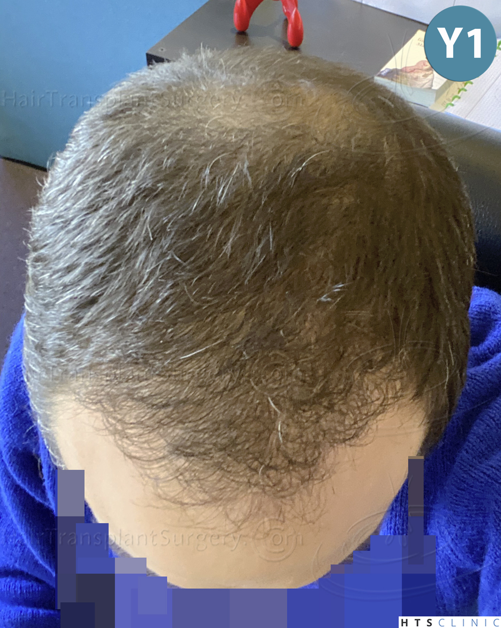 Dr.Devroye-HTS-Clinic-5530-FUE-_3545_198