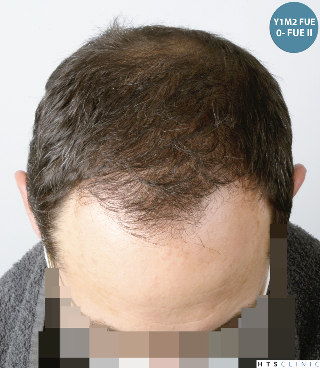 Dr.Devroye-HTS-Clinic-5530-FUE-_3545_198