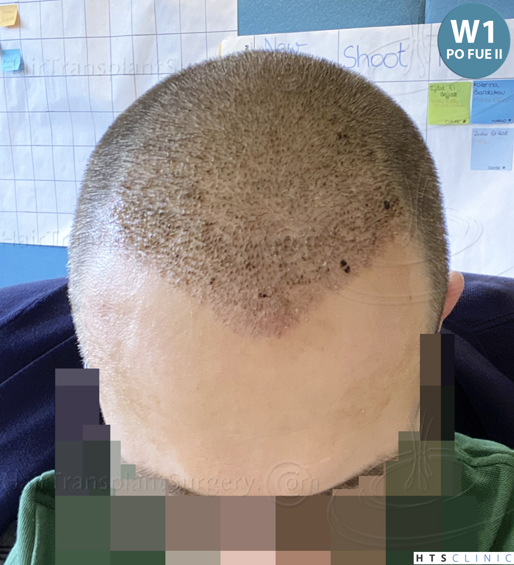 Dr.Devroye-HTS-Clinic-5530-FUE-_3545_198