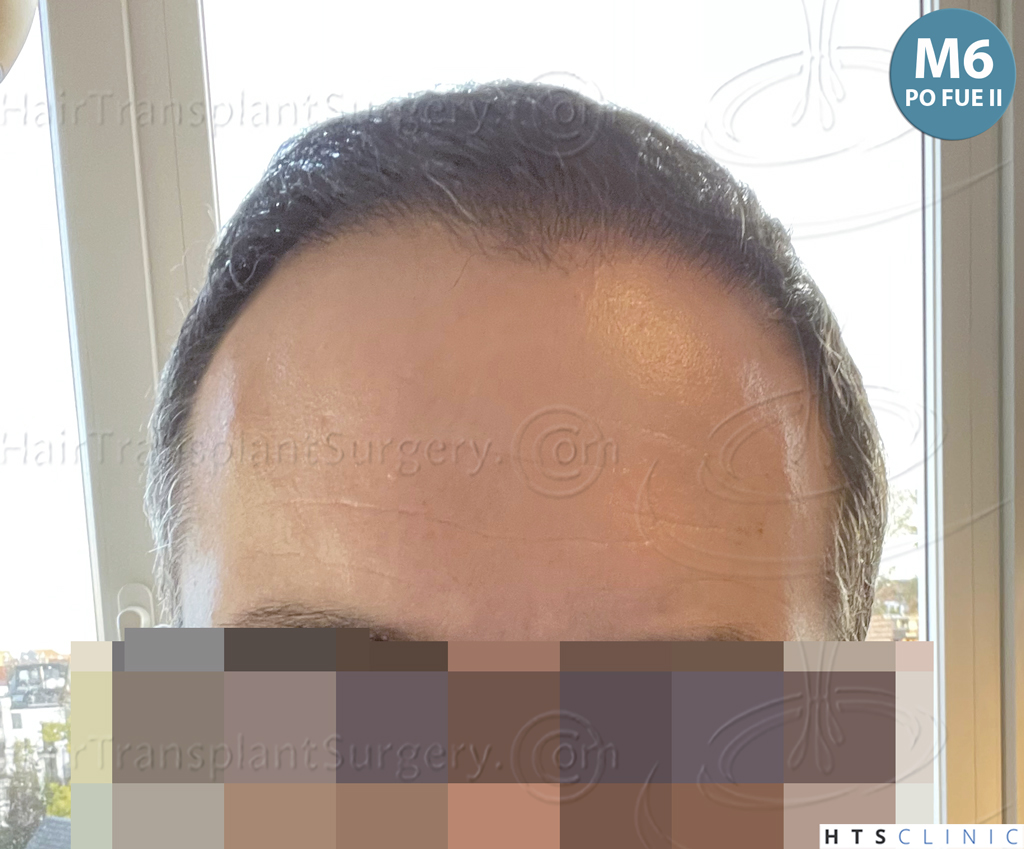 Dr.Devroye-HTS-Clinic-5530-FUE-_3545_198