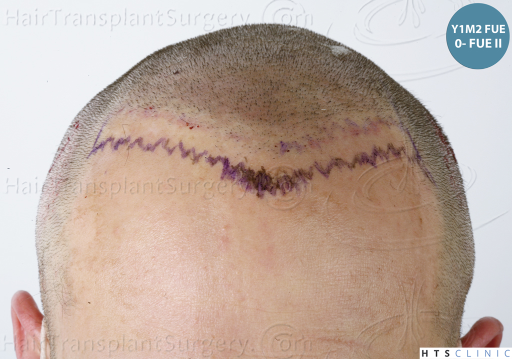 Dr.Devroye-HTS-Clinic-5530-FUE-_3545_198