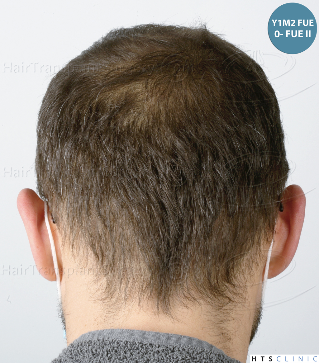 Dr.Devroye-HTS-Clinic-5530-FUE-_3545_198