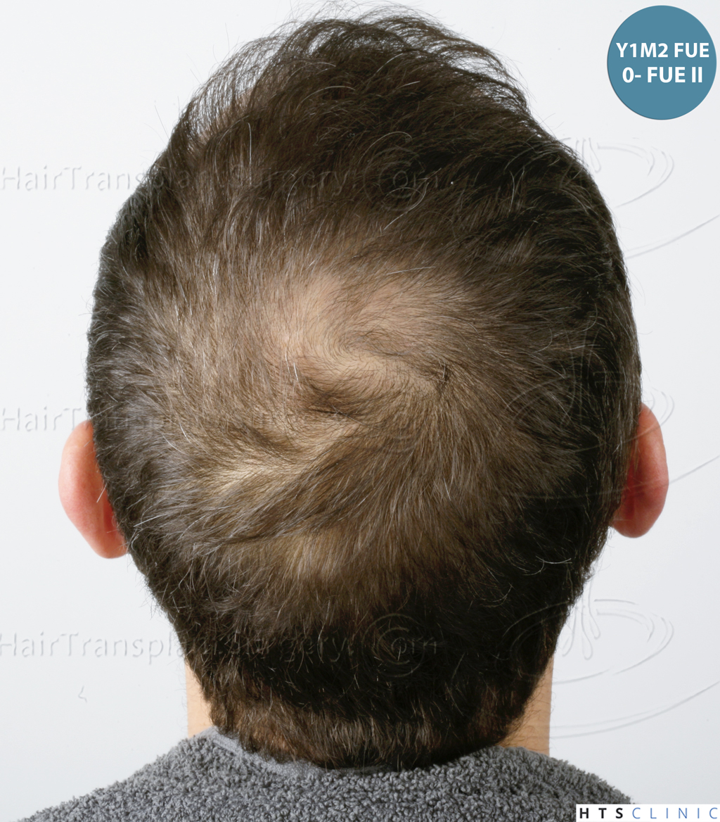 Dr.Devroye-HTS-Clinic-5530-FUE-_3545_198