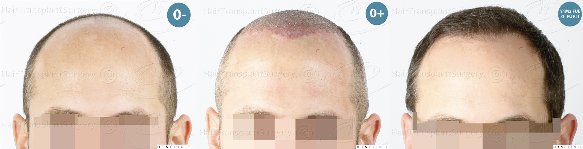 Dr.Devroye-HTS-Clinic-5530-FUE-_3545_198