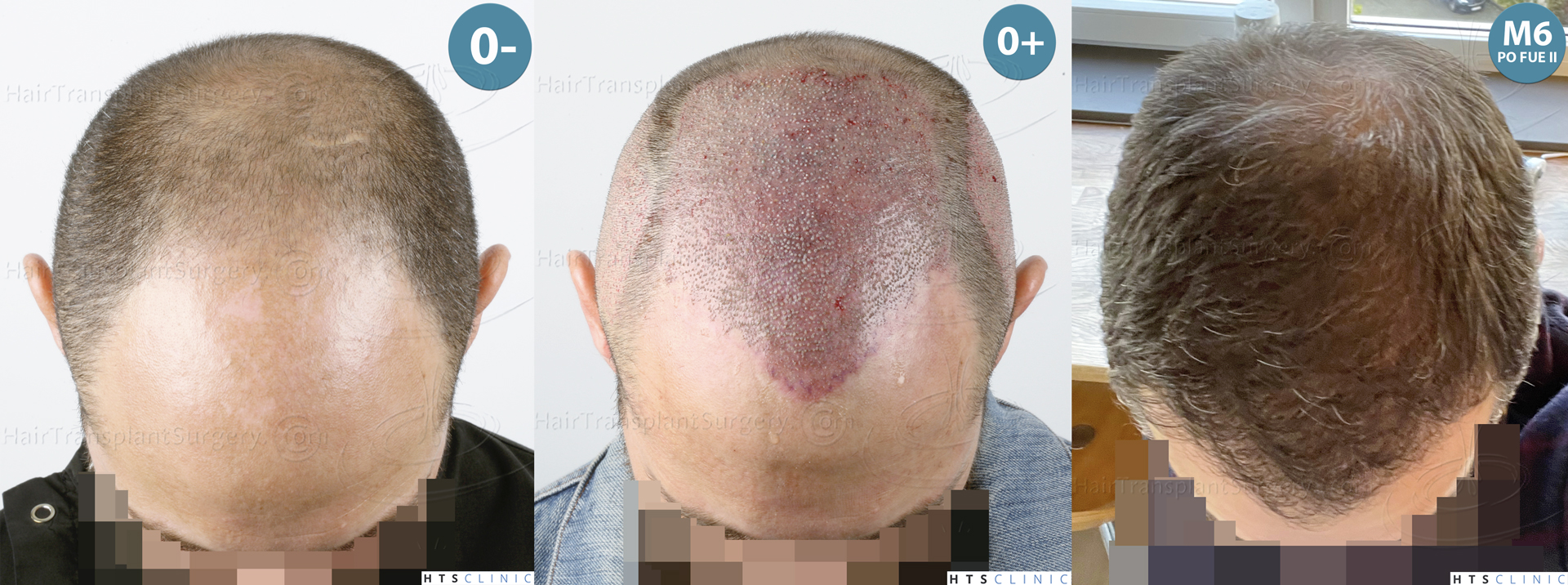 Dr.Devroye-HTS-Clinic-5530-FUE-_3545_198