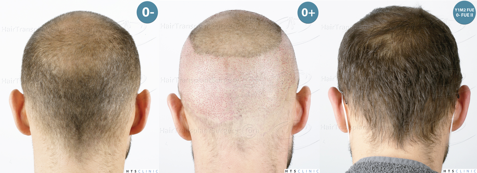 Dr.Devroye-HTS-Clinic-5530-FUE-_3545_198