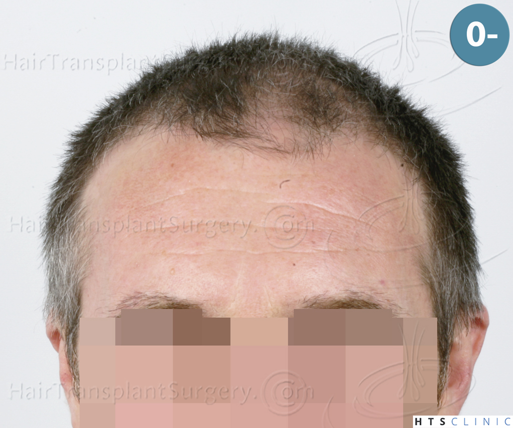 Dr.Devroye-HTS-Clinic-5913-FUE_BHT-1.jpg