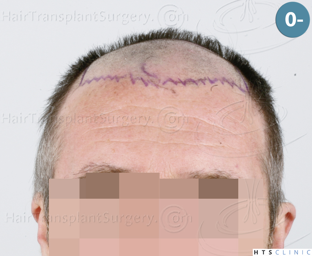 Dr.Devroye-HTS-Clinic-5913-FUE_BHT-9.jpg