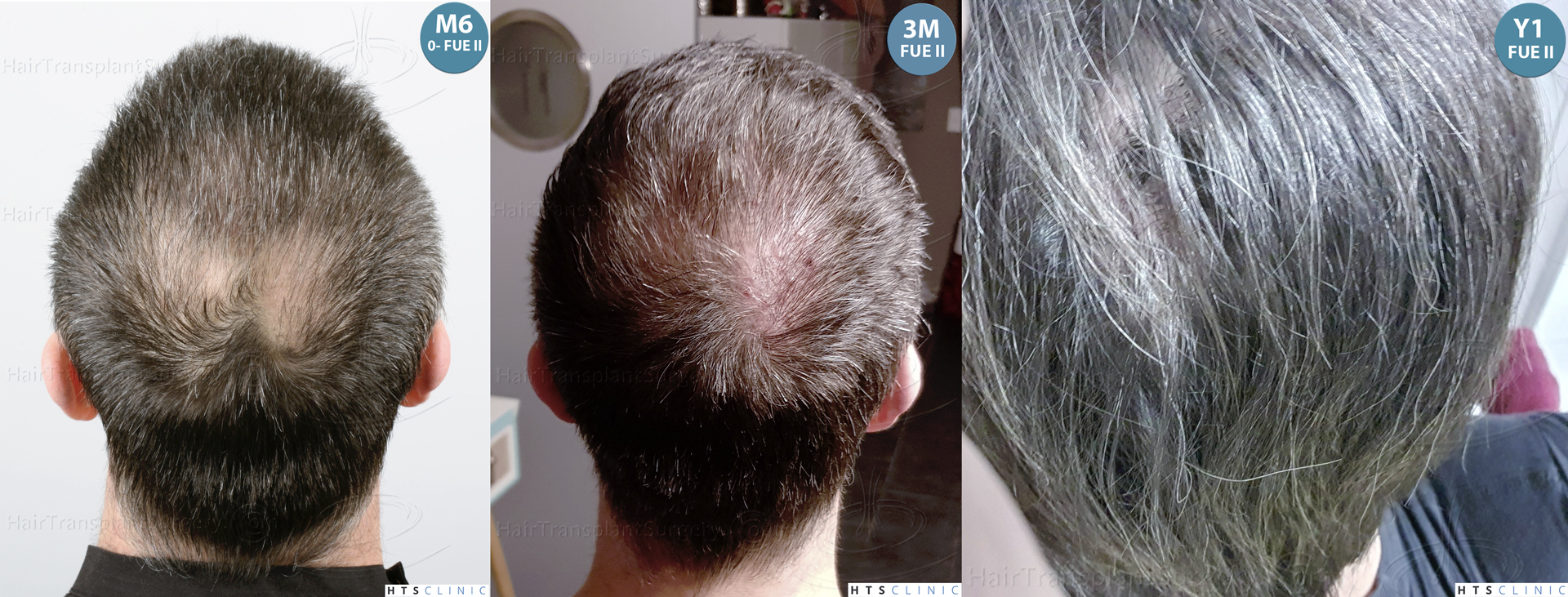 Dr.Devroye-HTS-Clinic-5913-FUE_BHT-Monta