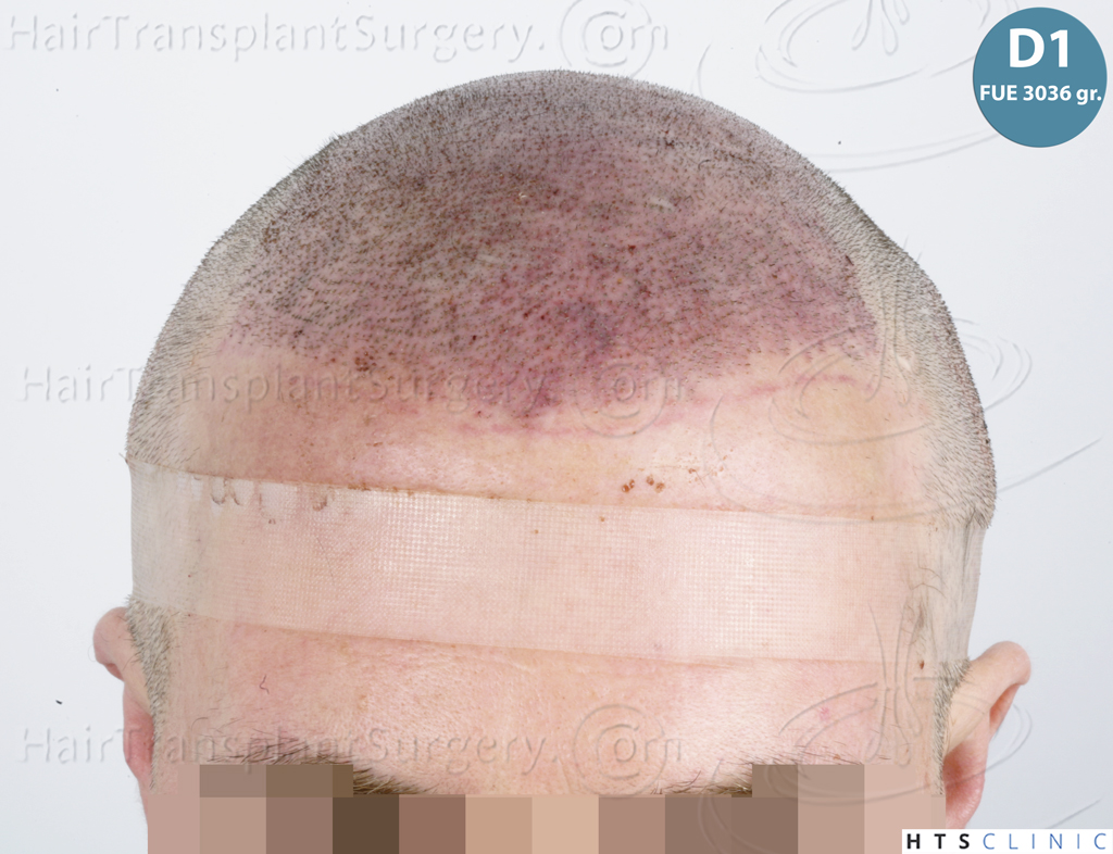 Dr.Devroye-HTS-Clinic-5913-FUE_BHT-11.jp