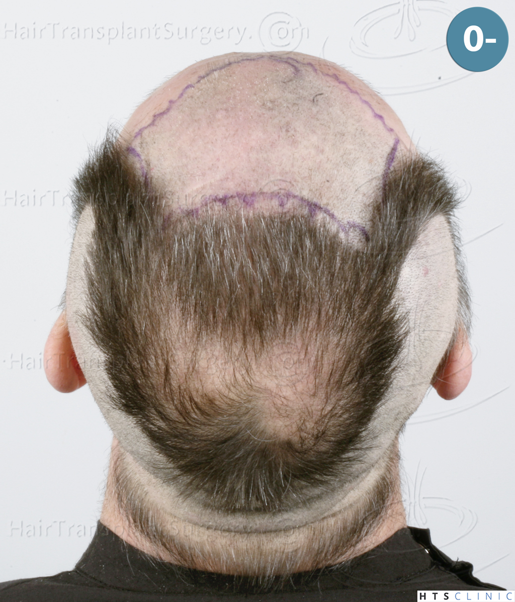 Dr.Devroye-HTS-Clinic-5913-FUE_BHT-10.jp