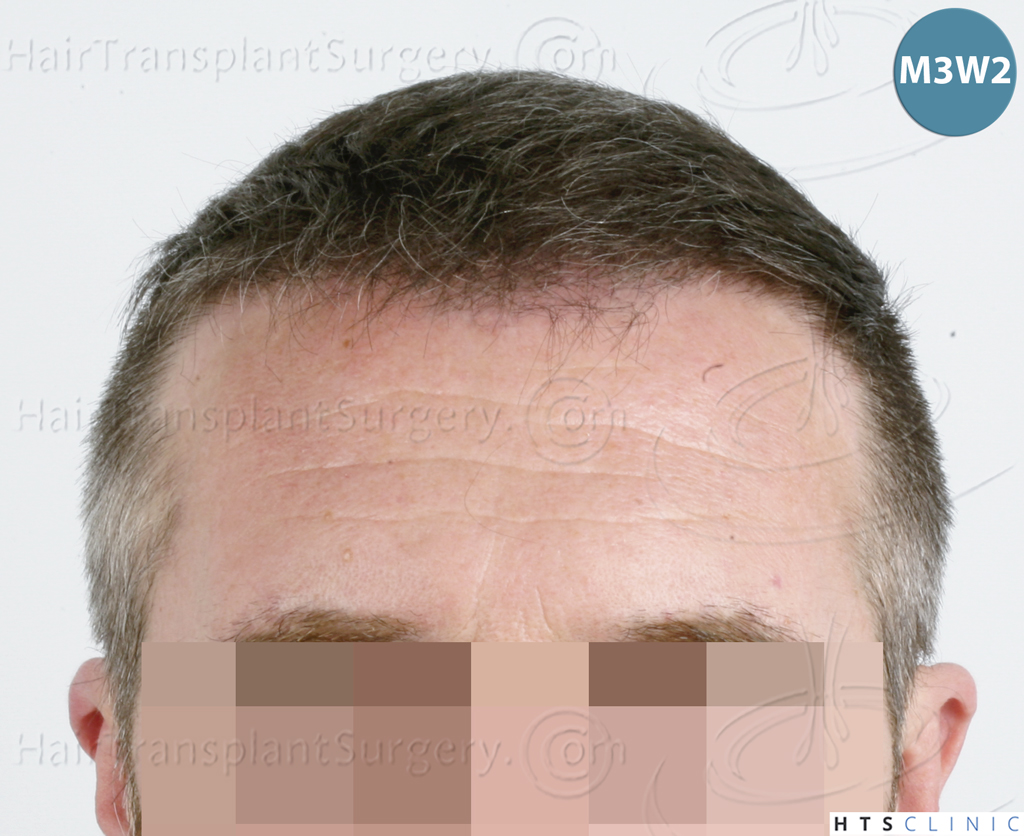 Dr.Devroye-HTS-Clinic-5913-FUE_BHT-14.jp