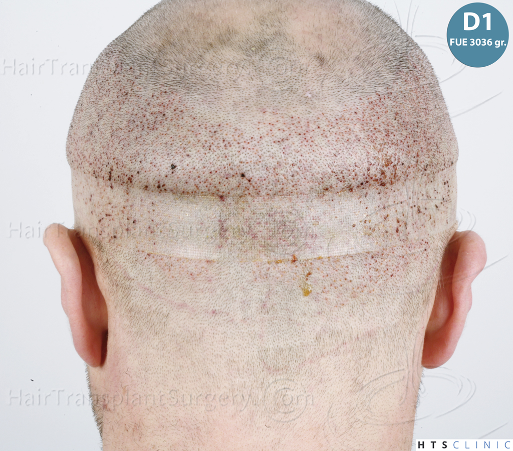 Dr.Devroye-HTS-Clinic-5913-FUE_BHT-13.jp