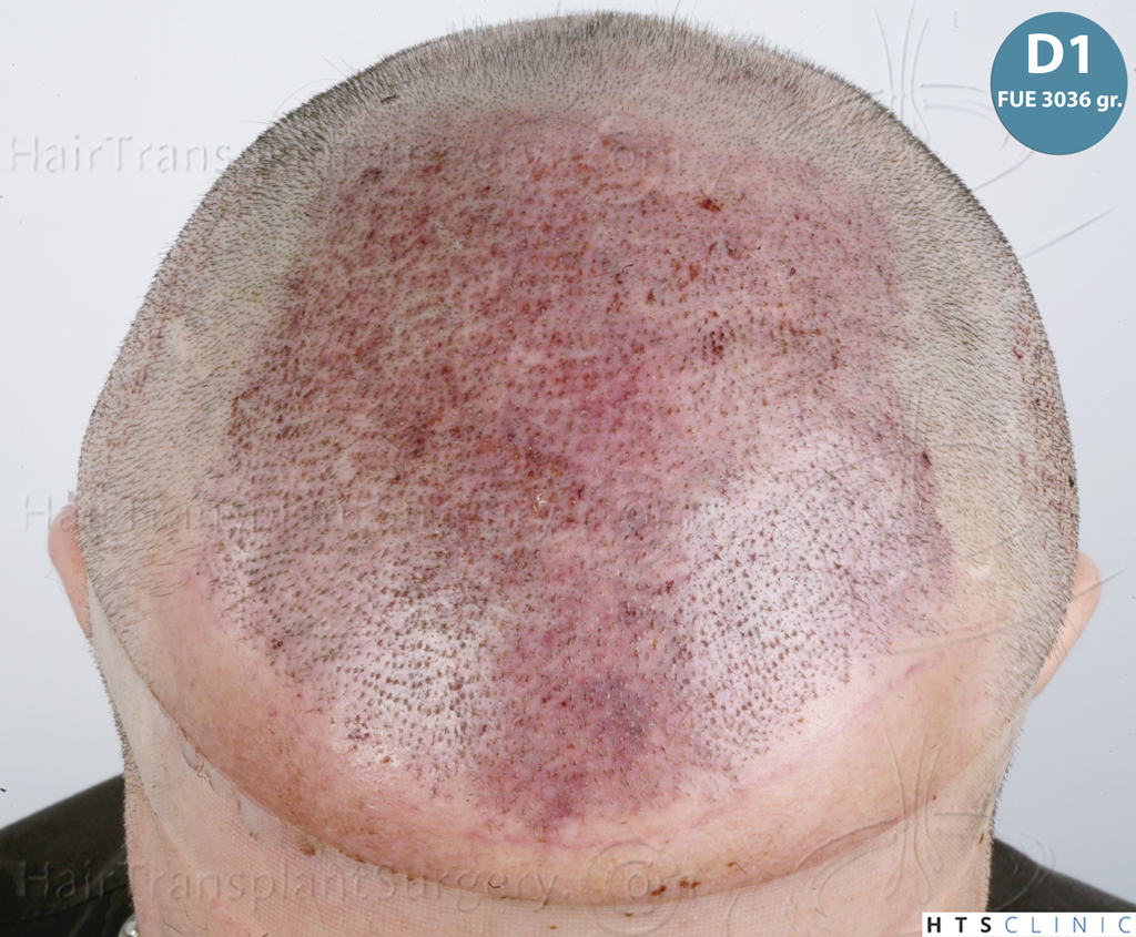 Dr.Devroye-HTS-Clinic-5913-FUE_BHT-12.jp