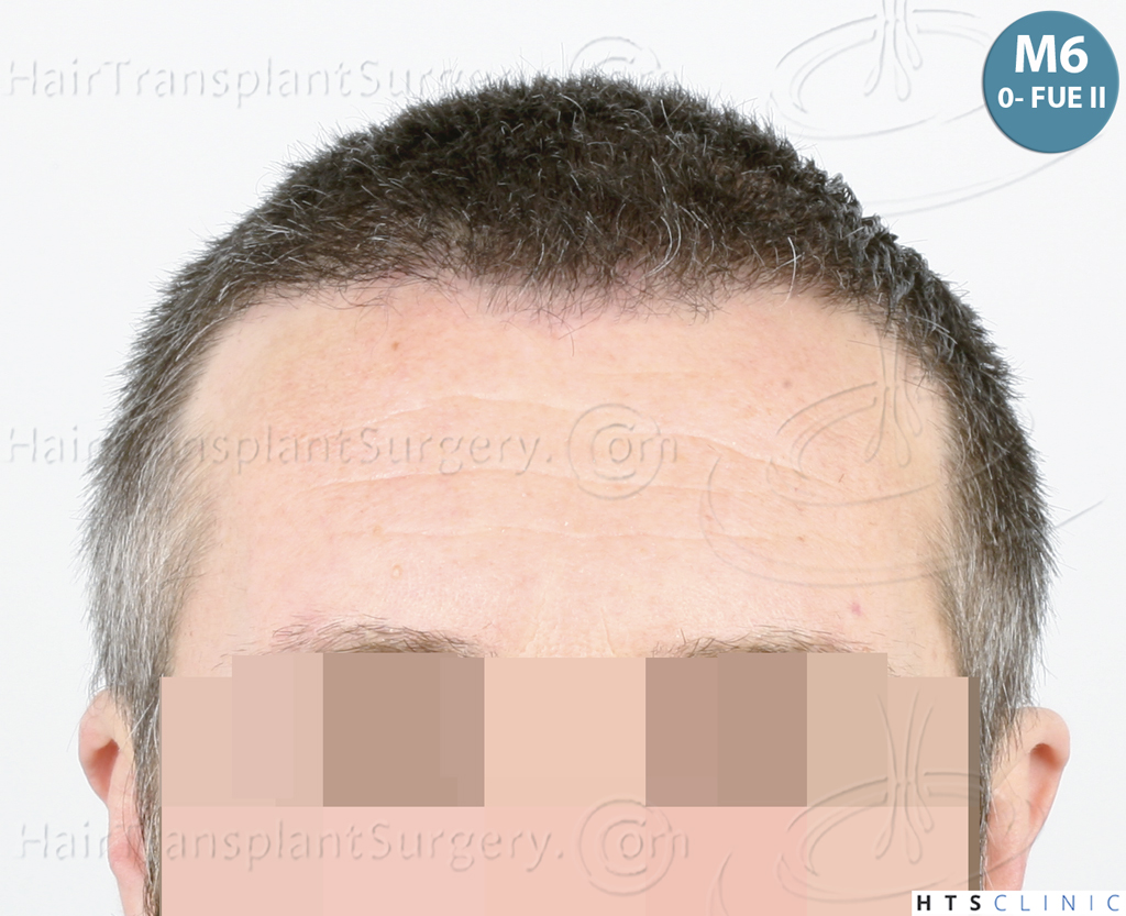 Dr.Devroye-HTS-Clinic-5913-FUE_BHT-19.jp