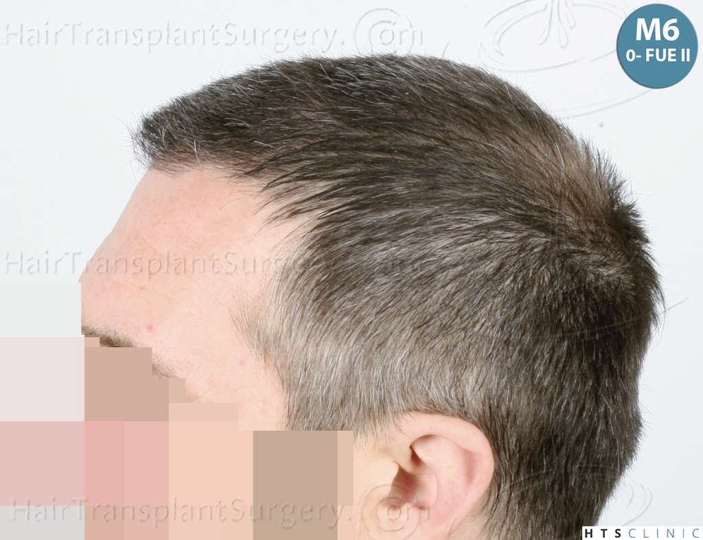 Dr.Devroye-HTS-Clinic-5913-FUE_BHT-21.jp