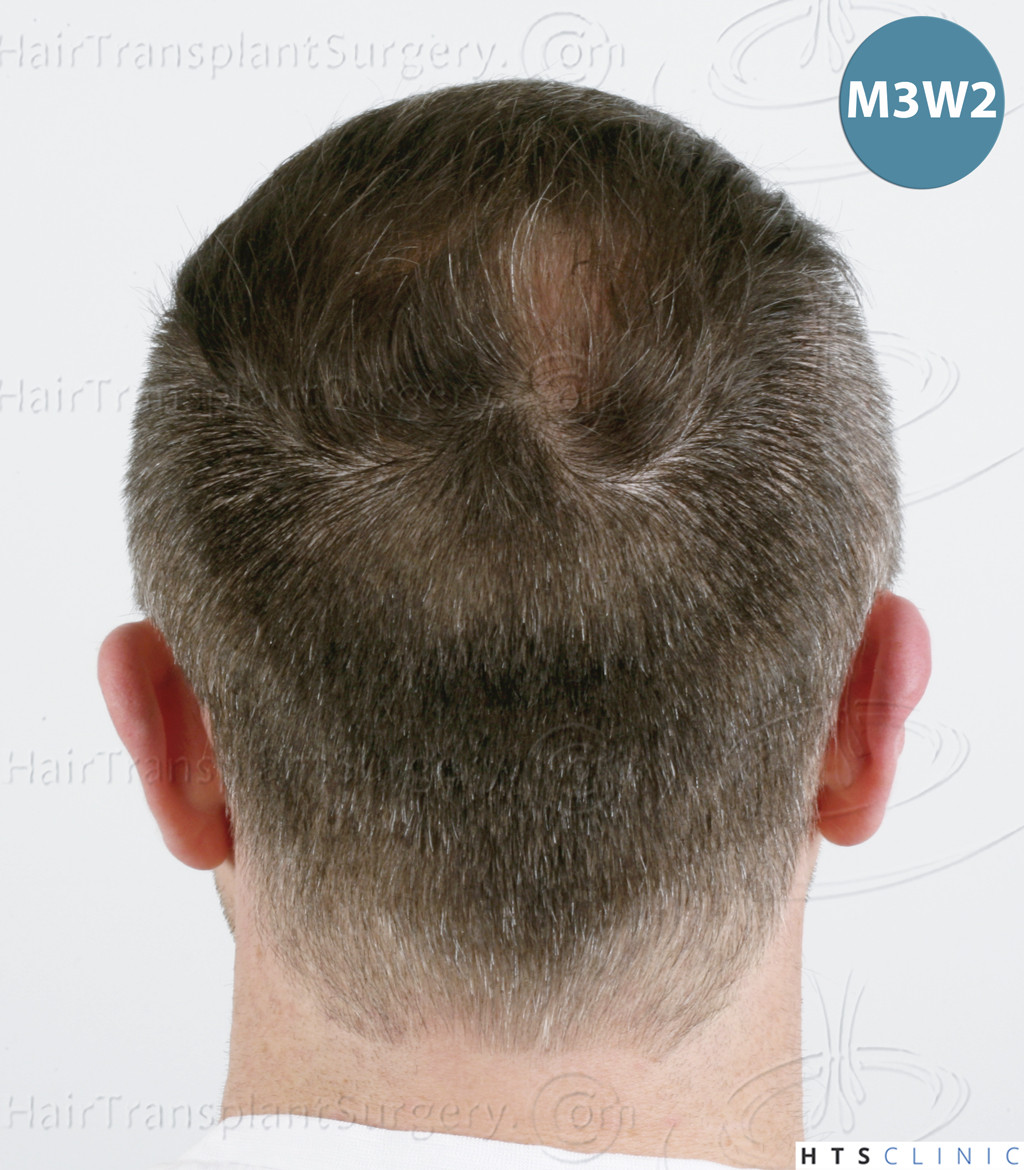 Dr.Devroye-HTS-Clinic-5913-FUE_BHT-18.jp