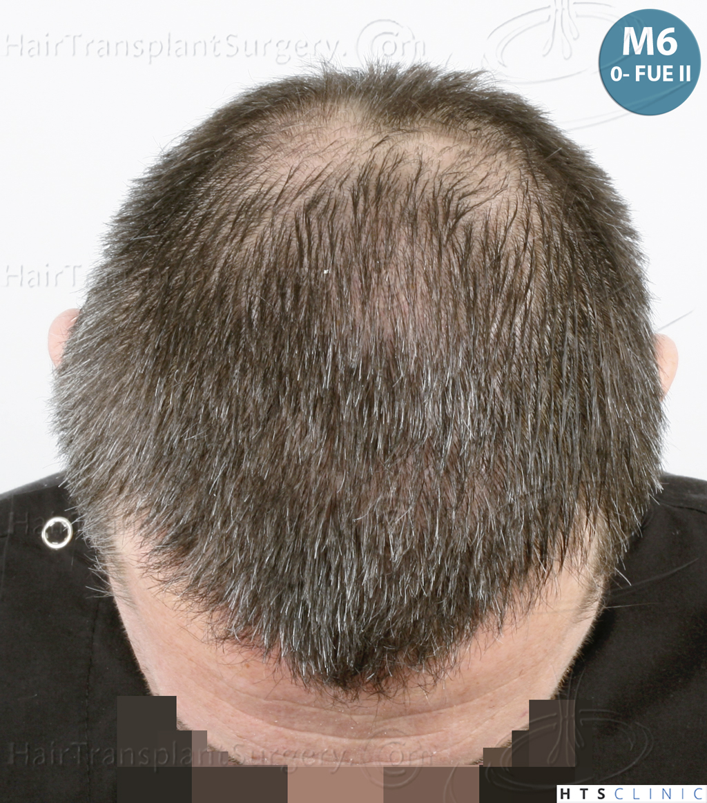 Dr.Devroye-HTS-Clinic-5913-FUE_BHT-20.jp