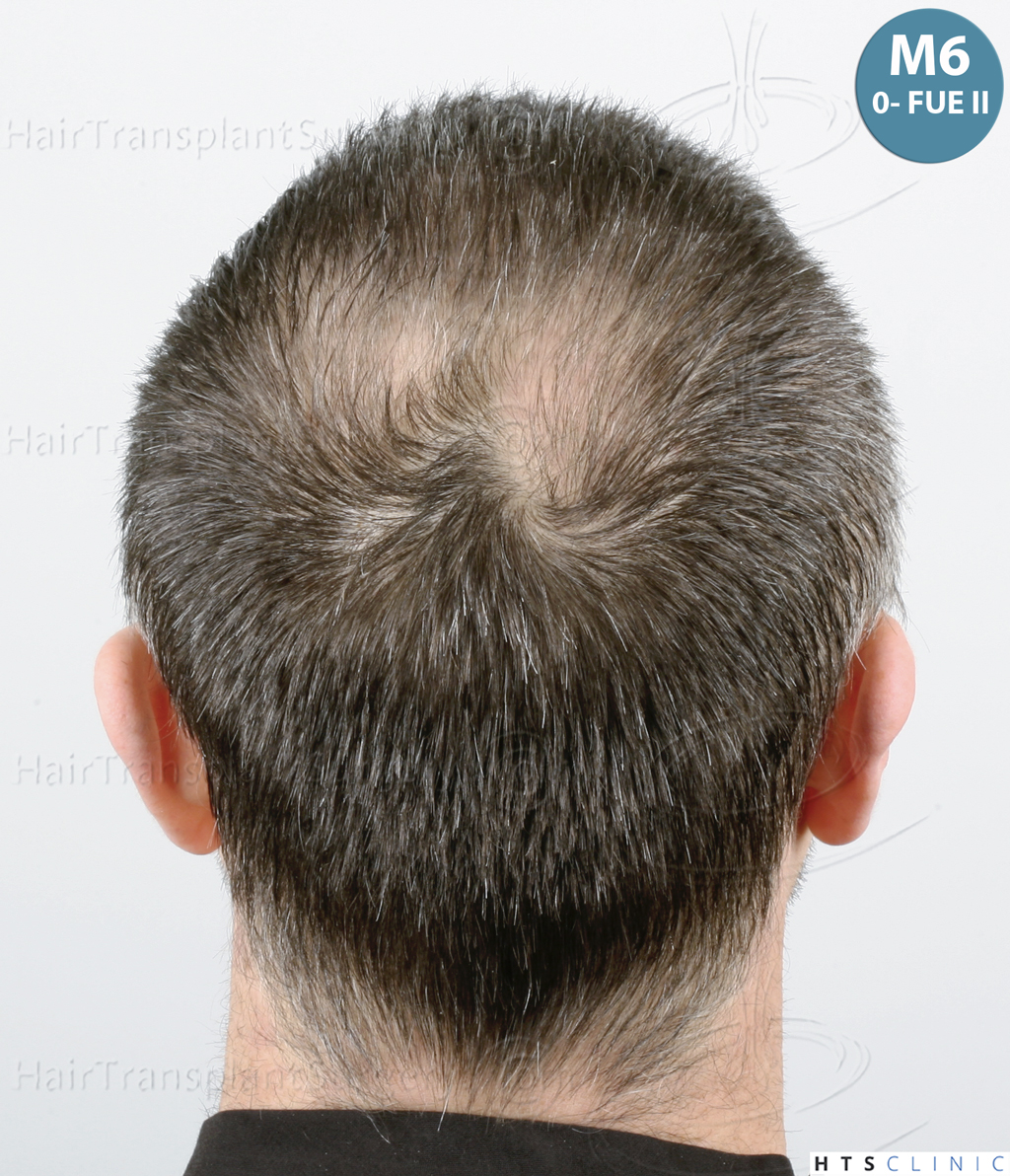 Dr.Devroye-HTS-Clinic-5913-FUE_BHT-25.jp