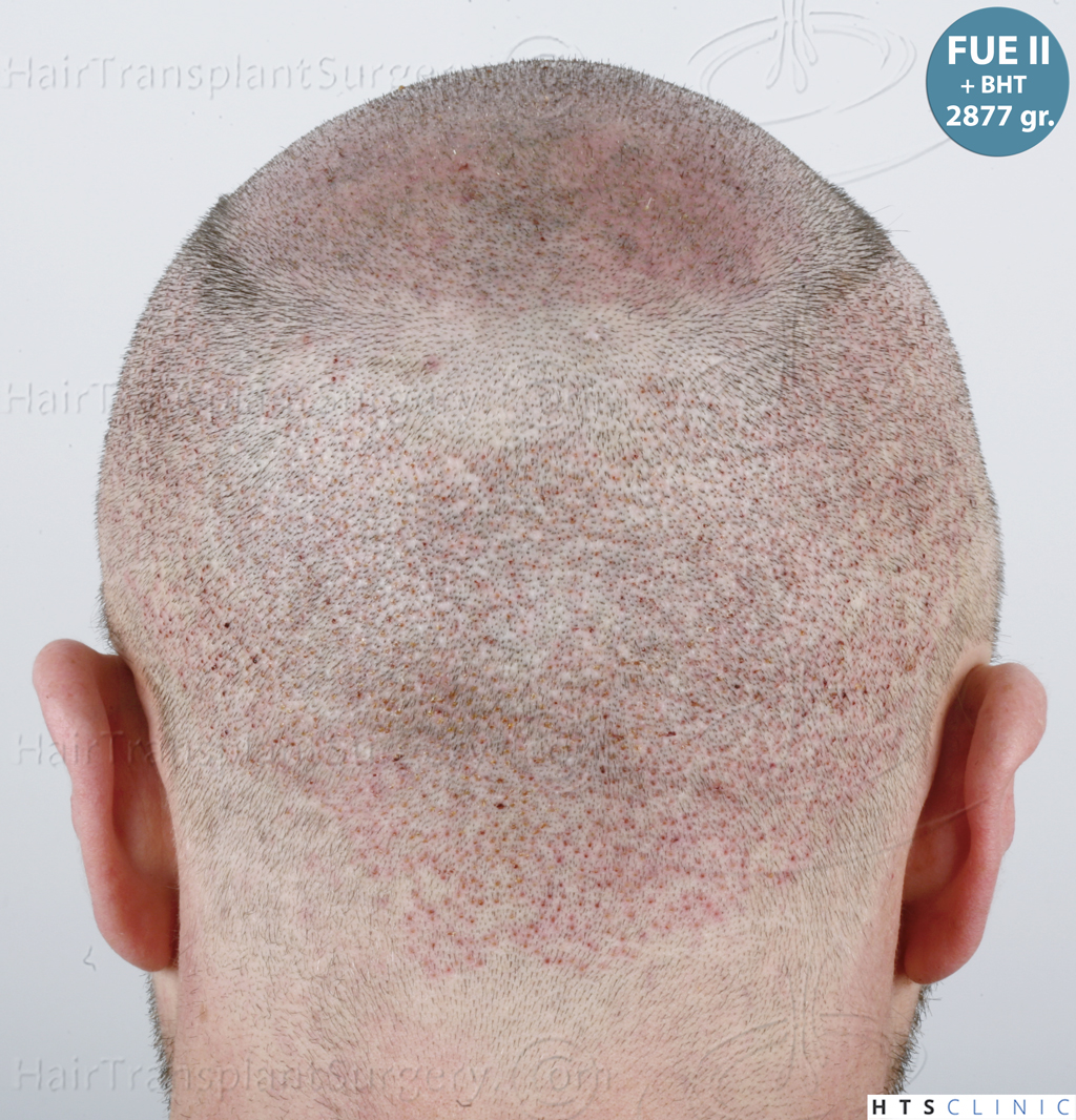 Dr.Devroye-HTS-Clinic-5913-FUE_BHT-30.jp