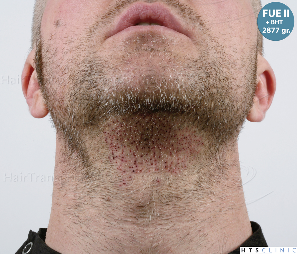 Dr.Devroye-HTS-Clinic-5913-FUE_BHT-32.jp