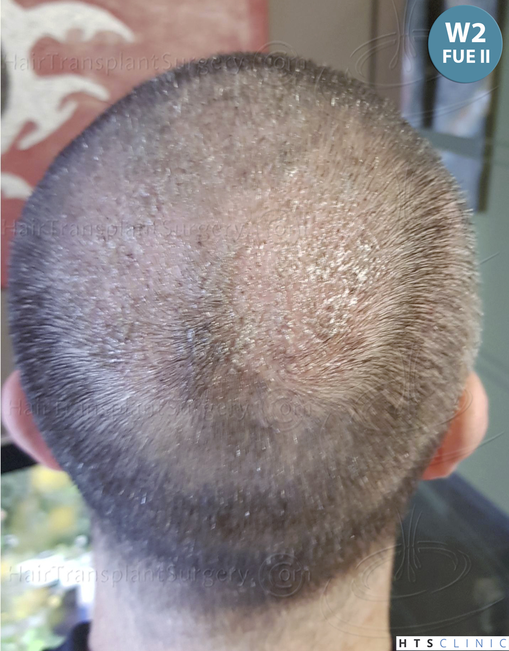 Dr.Devroye-HTS-Clinic-5913-FUE_BHT-34.jp