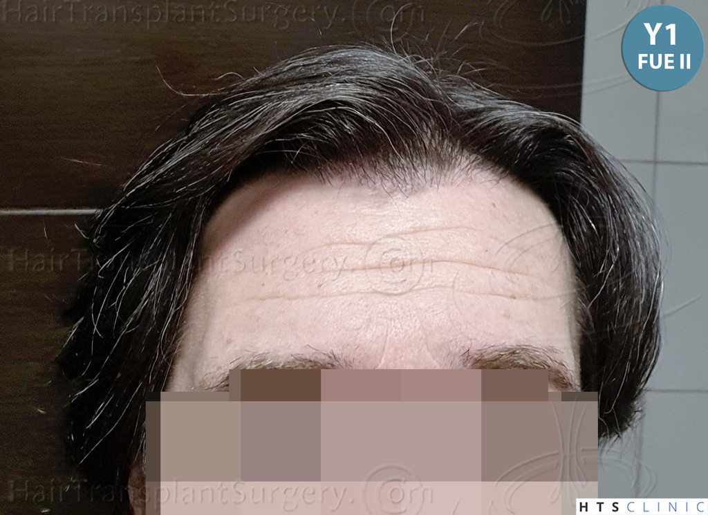 Dr.Devroye-HTS-Clinic-5913-FUE_BHT-37.jp