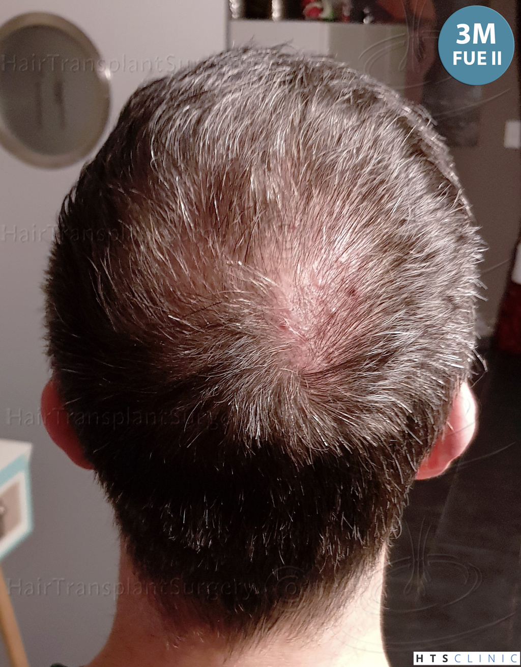 Dr.Devroye-HTS-Clinic-5913-FUE_BHT-36.jp