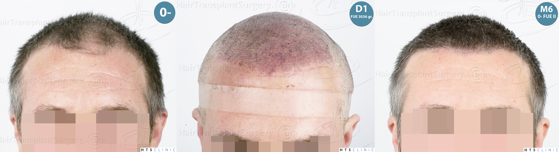 Dr.Devroye-HTS-Clinic-5913-FUE_BHT-Monta