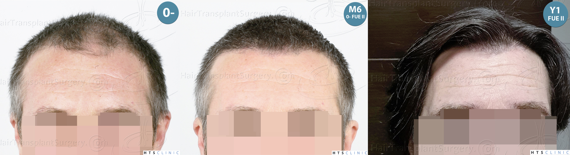 Dr.Devroye-HTS-Clinic-5913-FUE_BHT-Monta