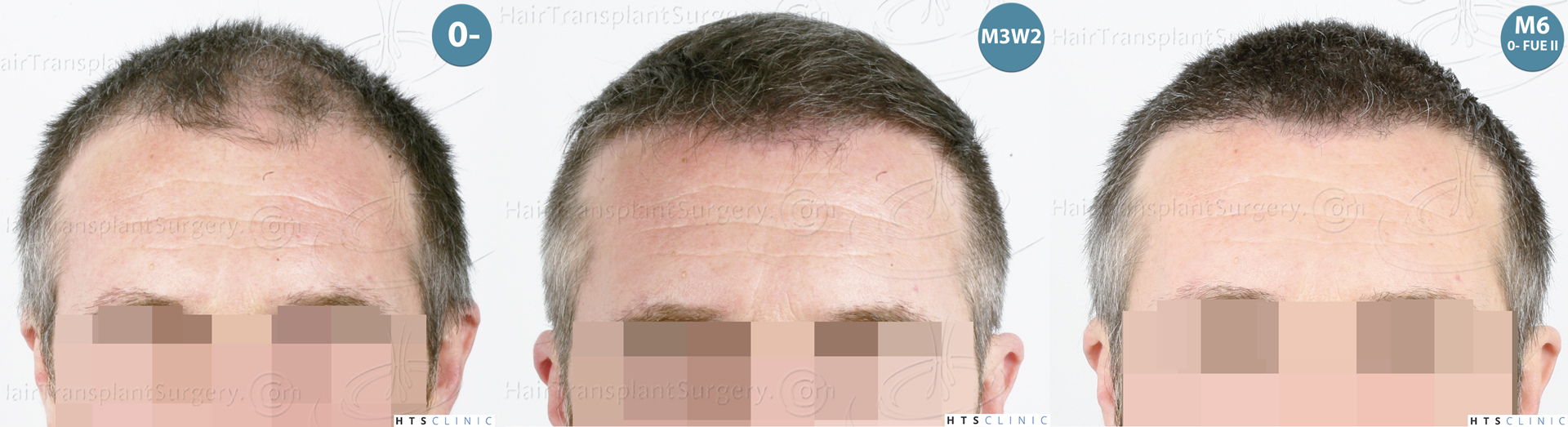 Dr.Devroye-HTS-Clinic-5913-FUE_BHT-Monta