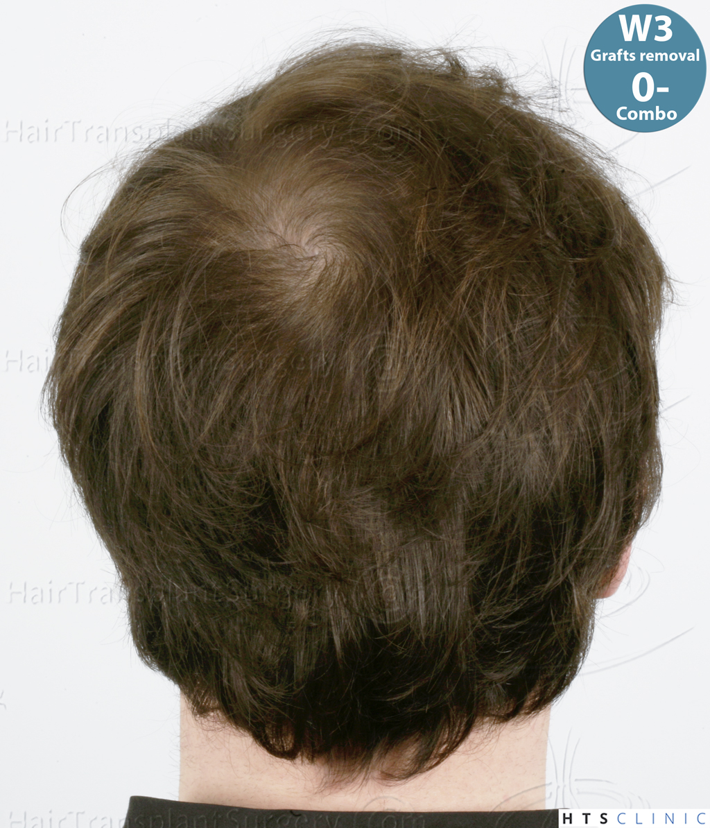 Dr.Devroye-HTS-Clinic-Grafts-Removal_393