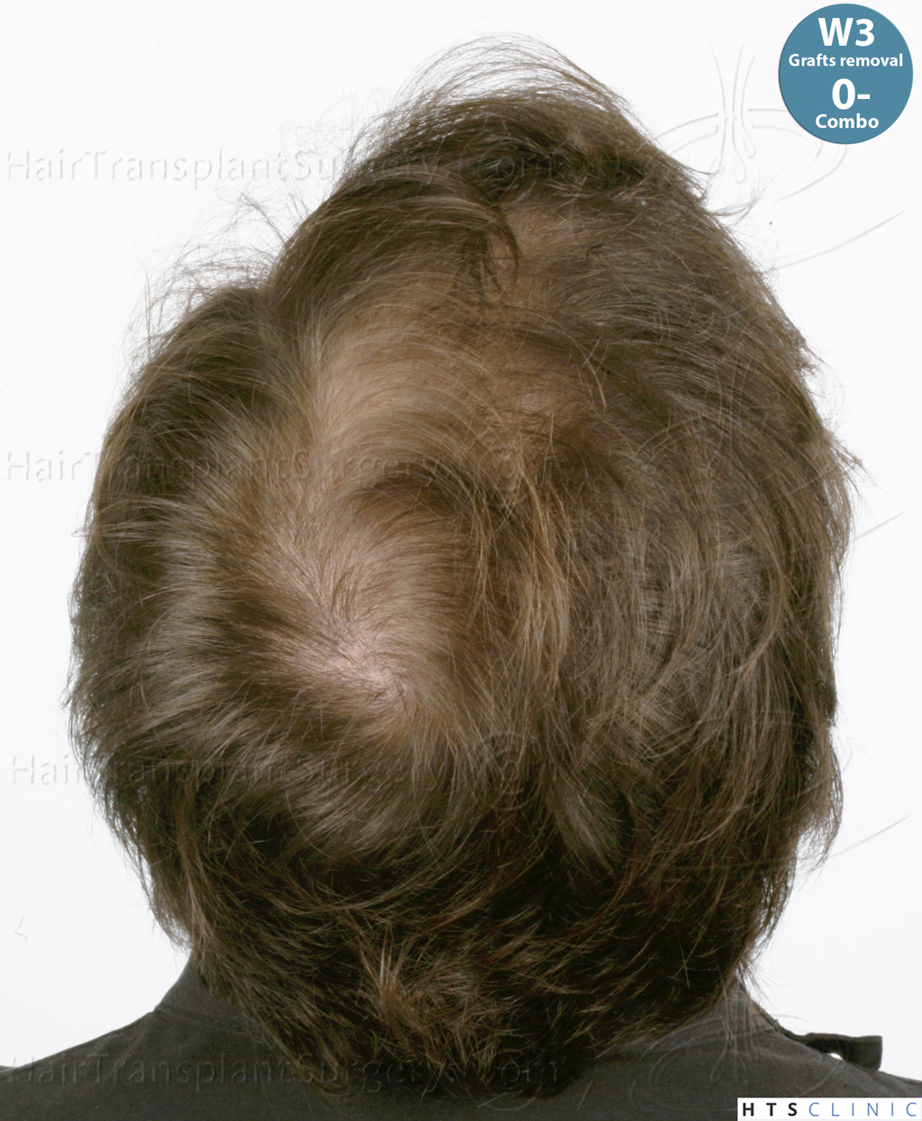 Dr.Devroye-HTS-Clinic-Grafts-Removal_393