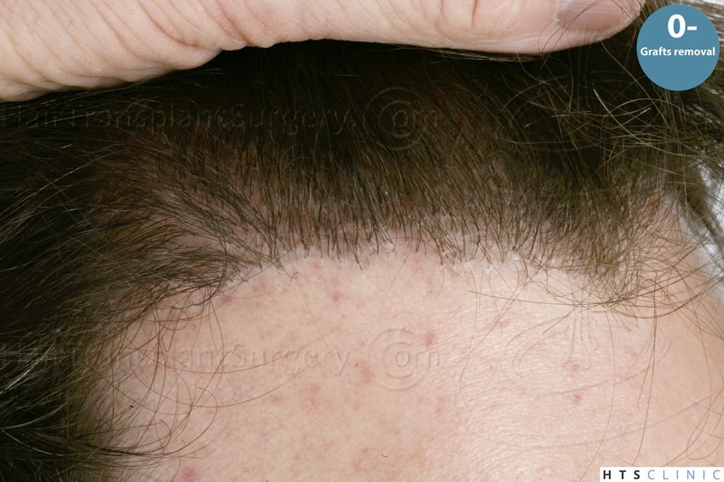 Dr.Devroye-HTS-Clinic-Grafts-Removal_393