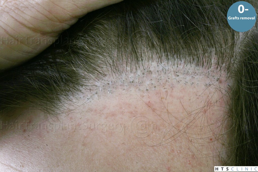 Dr.Devroye-HTS-Clinic-Grafts-Removal_393