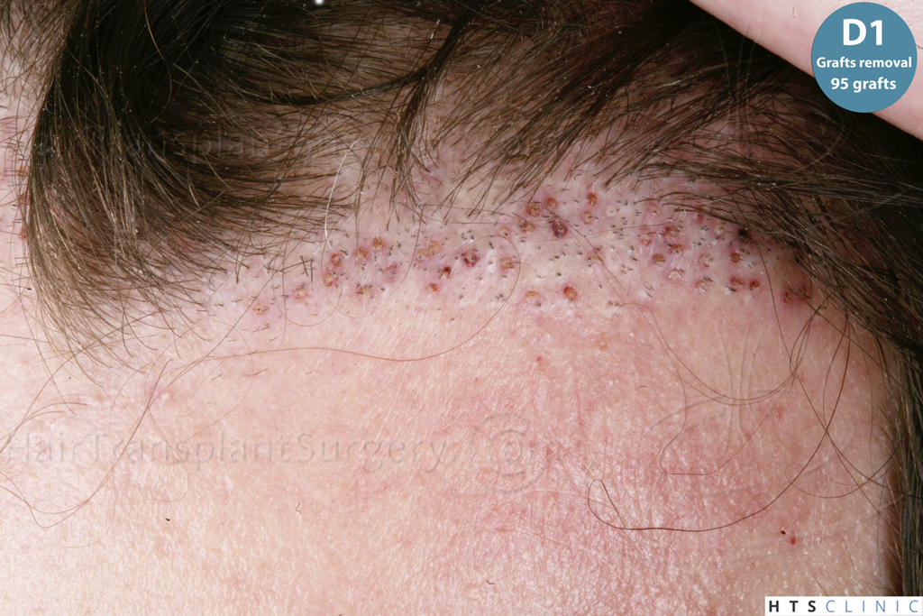 Dr.Devroye-HTS-Clinic-Grafts-Removal_393