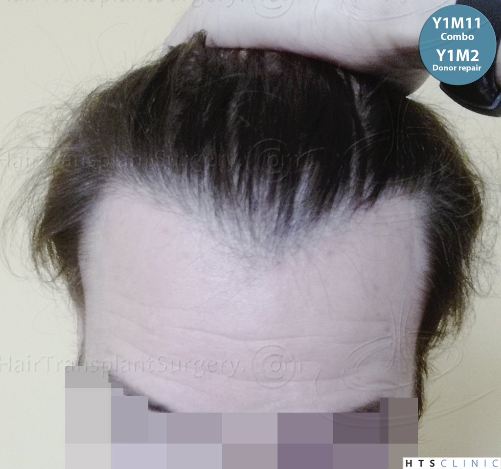 Dr.Devroye-HTS-Clinic-Grafts-Removal_393