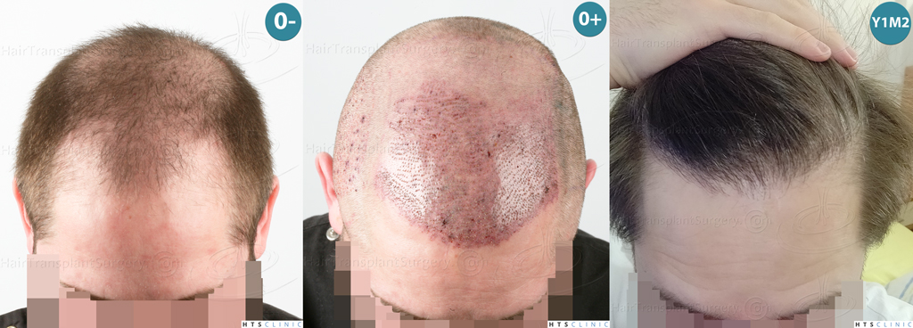 Dr.Devroye-HTS-Clinic-3523-FUE-NW-V-Mont