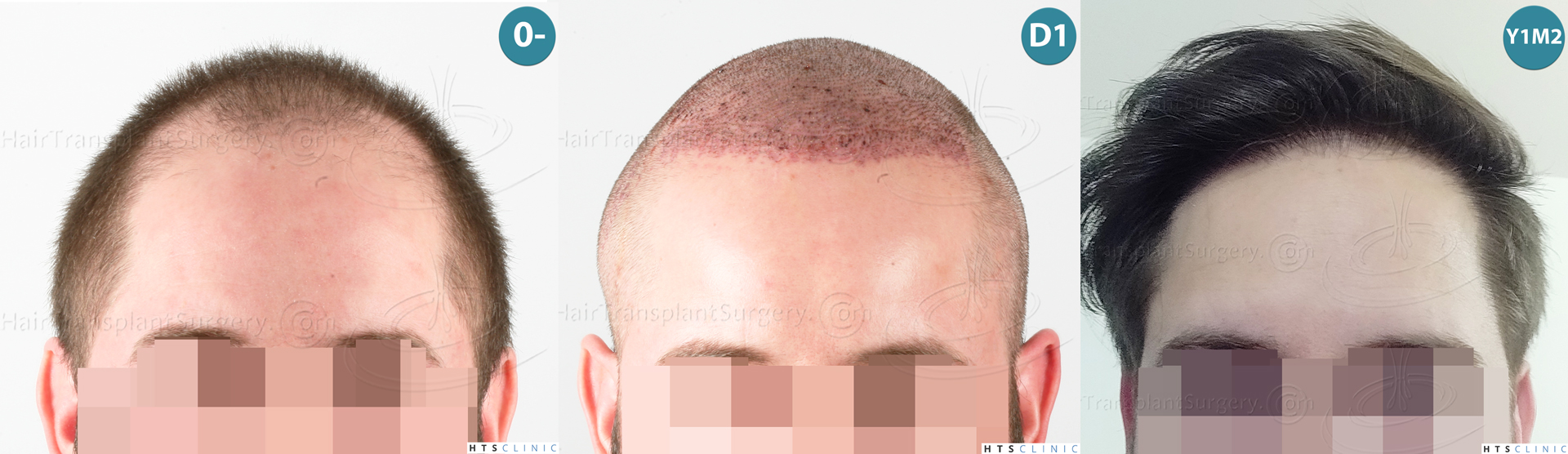 Dr.Devroye-HTS-Clinic-3523-FUE-NW-V-Mont