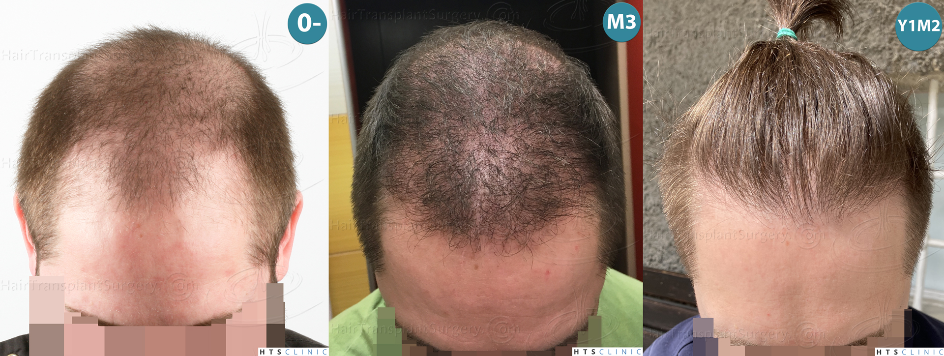 Dr.Devroye-HTS-Clinic-3523-FUE-NW-V-Mont