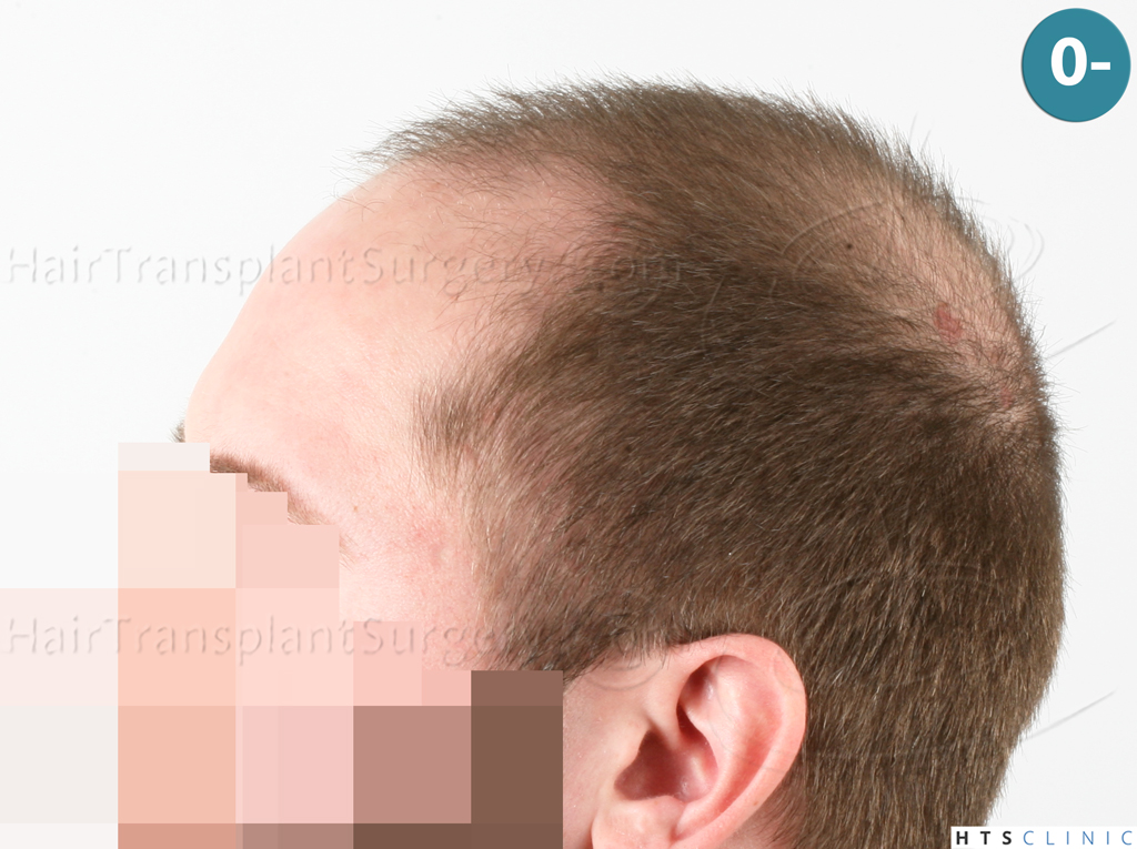 Dr.Devroye-HTS-Clinic-3523-FUE-NW-V-3.jp