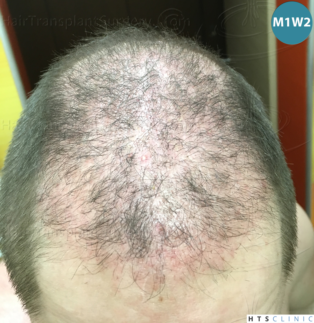 Dr.Devroye-HTS-Clinic-3523-FUE-NW-V-16.j