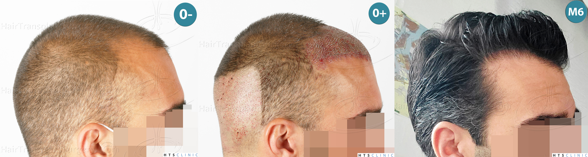 Dr.Devroye-HTS-Clinic-2258-FUE-Montage-4