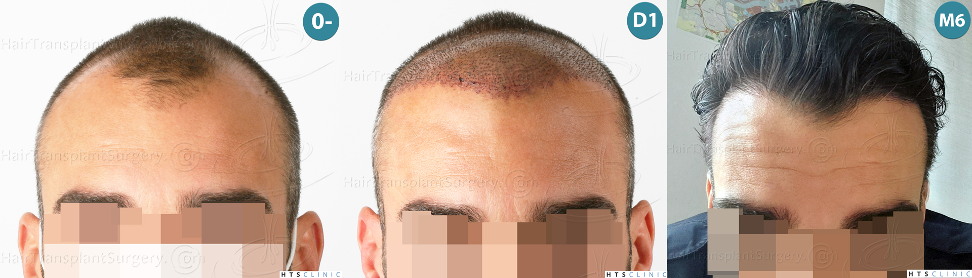 Dr.Devroye-HTS-Clinic-2258-FUE-Montage-1