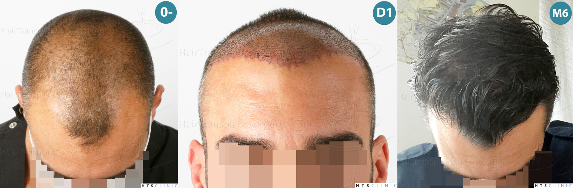 Dr.Devroye-HTS-Clinic-2258-FUE-Montage-3