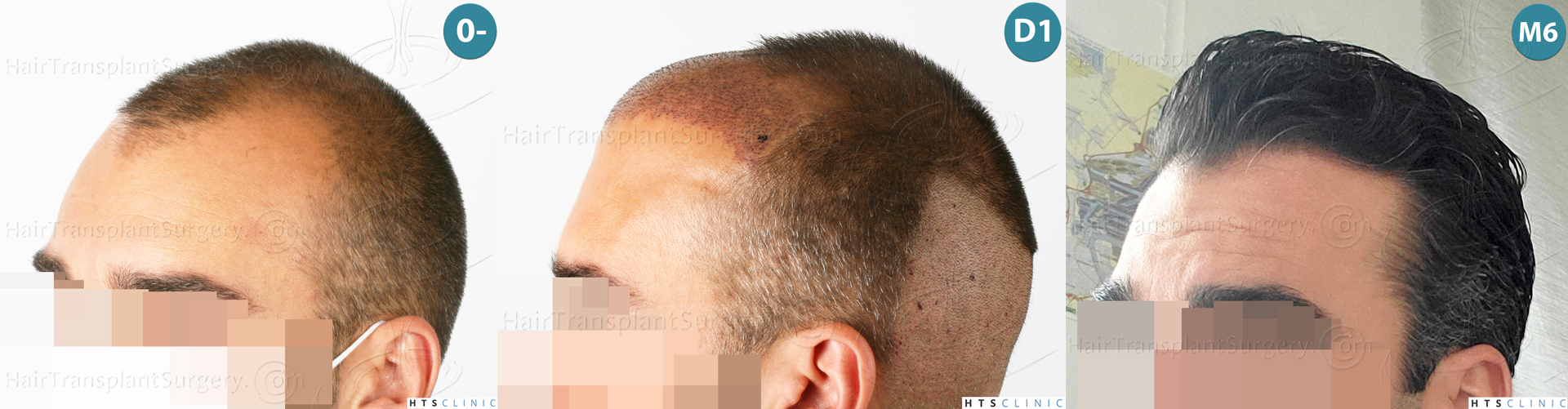 Dr.Devroye-HTS-Clinic-2258-FUE-Montage-5