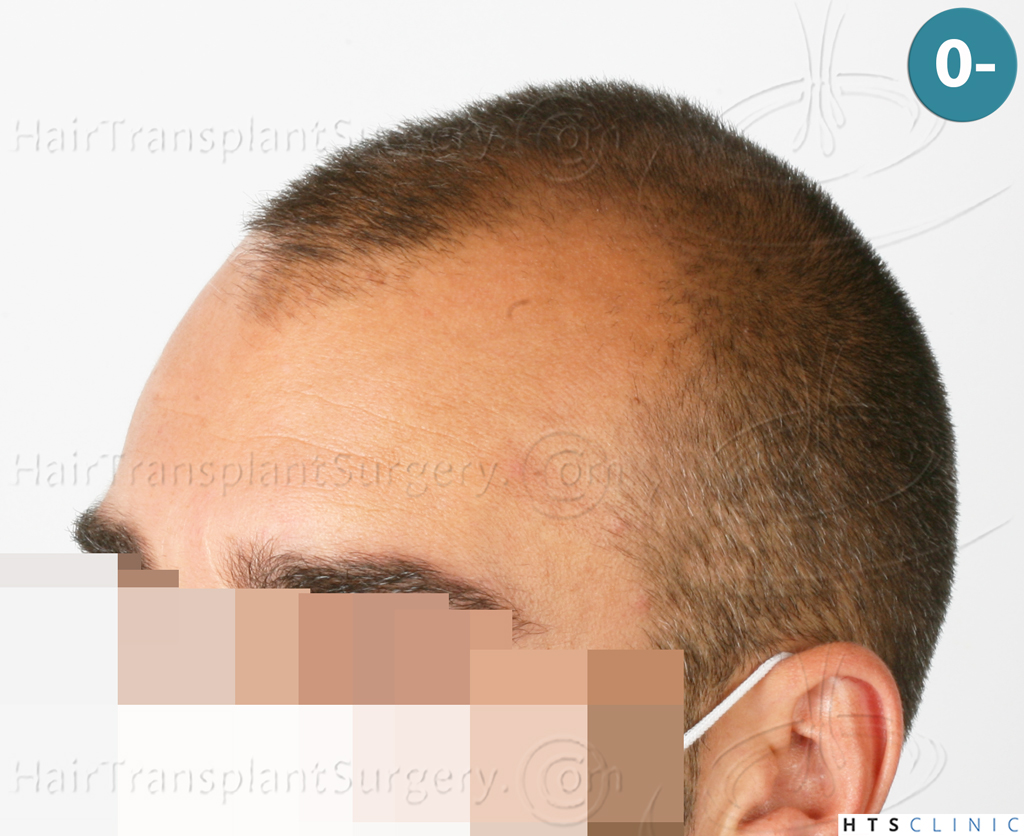 Dr.Devroye-HTS-Clinic-2258-FUE-4